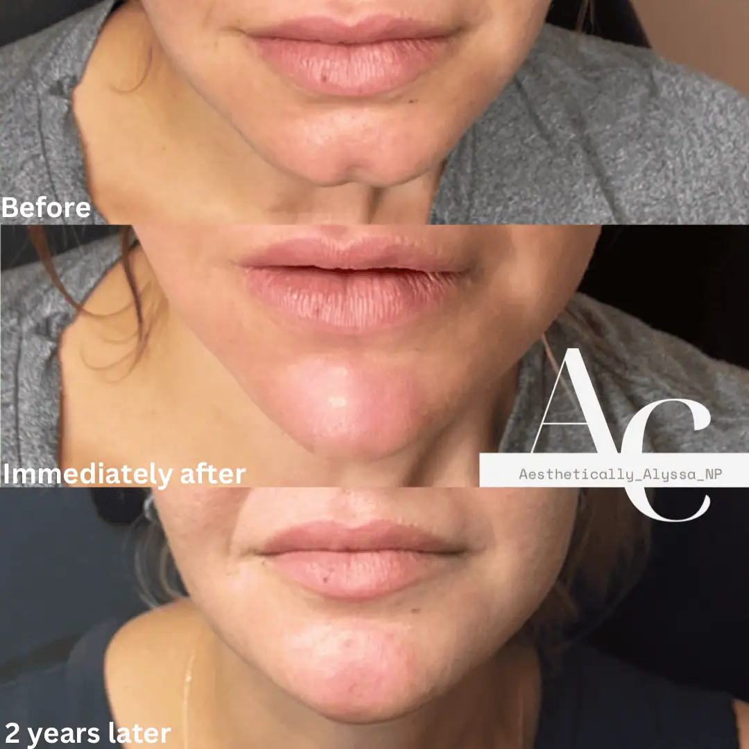 Lip Filler in New York | Timelyss Med Spa
