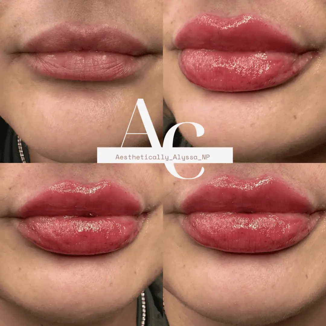 Lip Filler Services in New York by Timelyss Med Spa