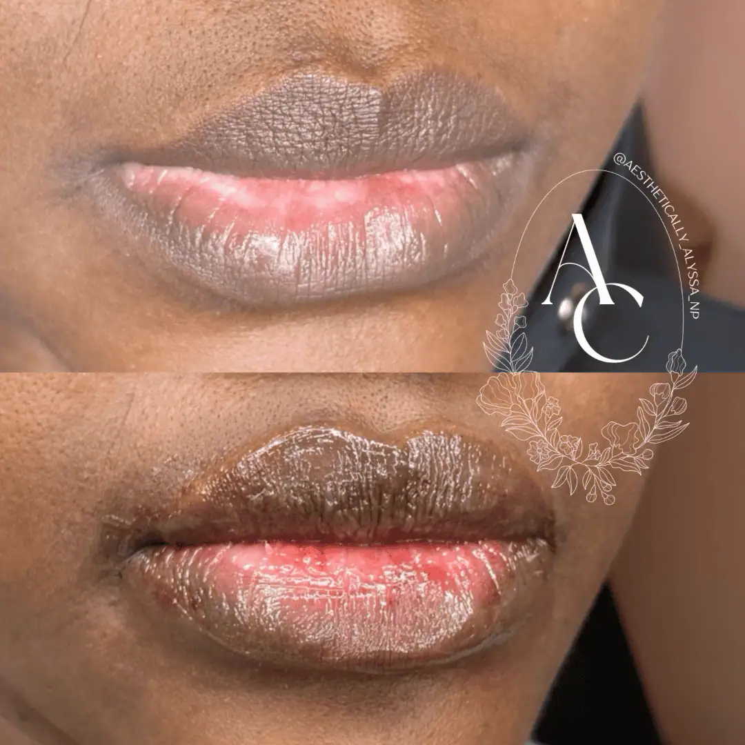 Lip Filler Services in New York by Timelyss Med Spa