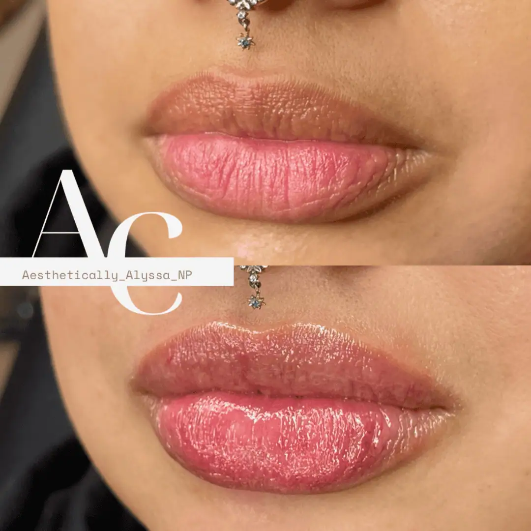 Lip Filler Services in New York by Timelyss Med Spa