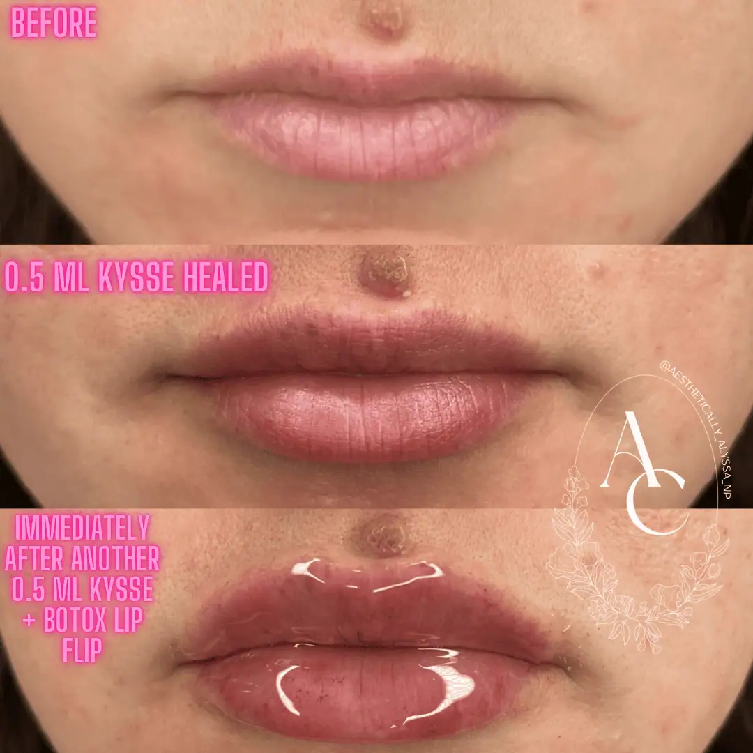 Lip Filler Services in New York by Timelyss Med Spa