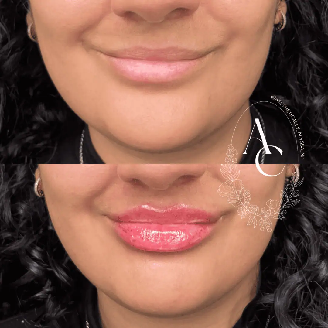 Lip Filler Services in New York by Timelyss Med Spa