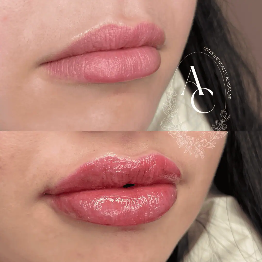 Lip Filler Services in New York by Timelyss Med Spa