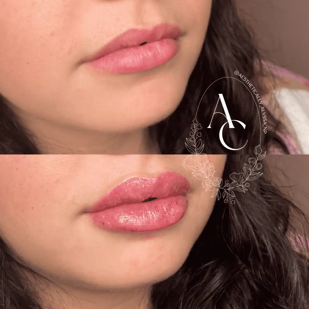 Lip Filler Services in New York by Timelyss Med Spa