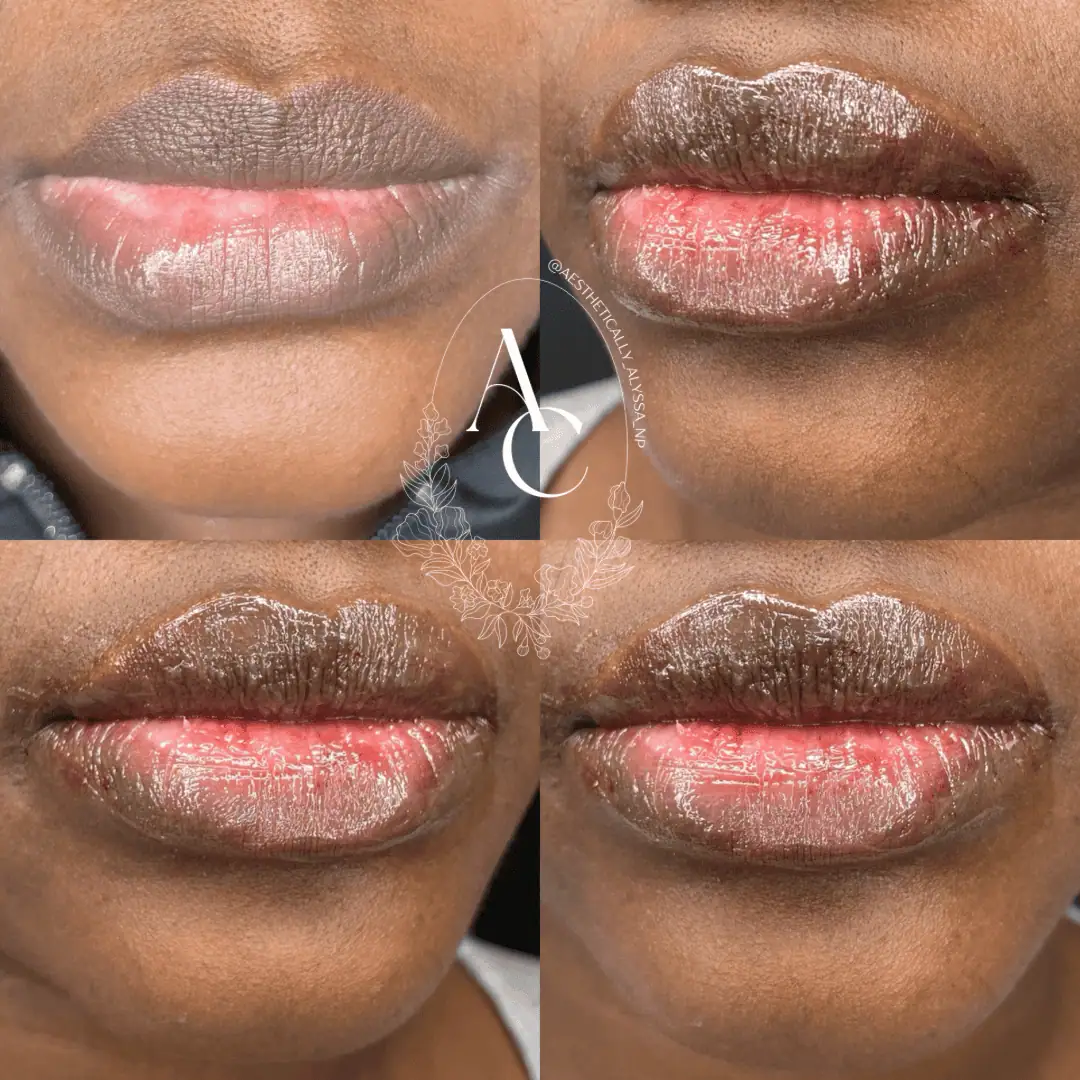 Lip Filler Services in New York by Timelyss Med Spa