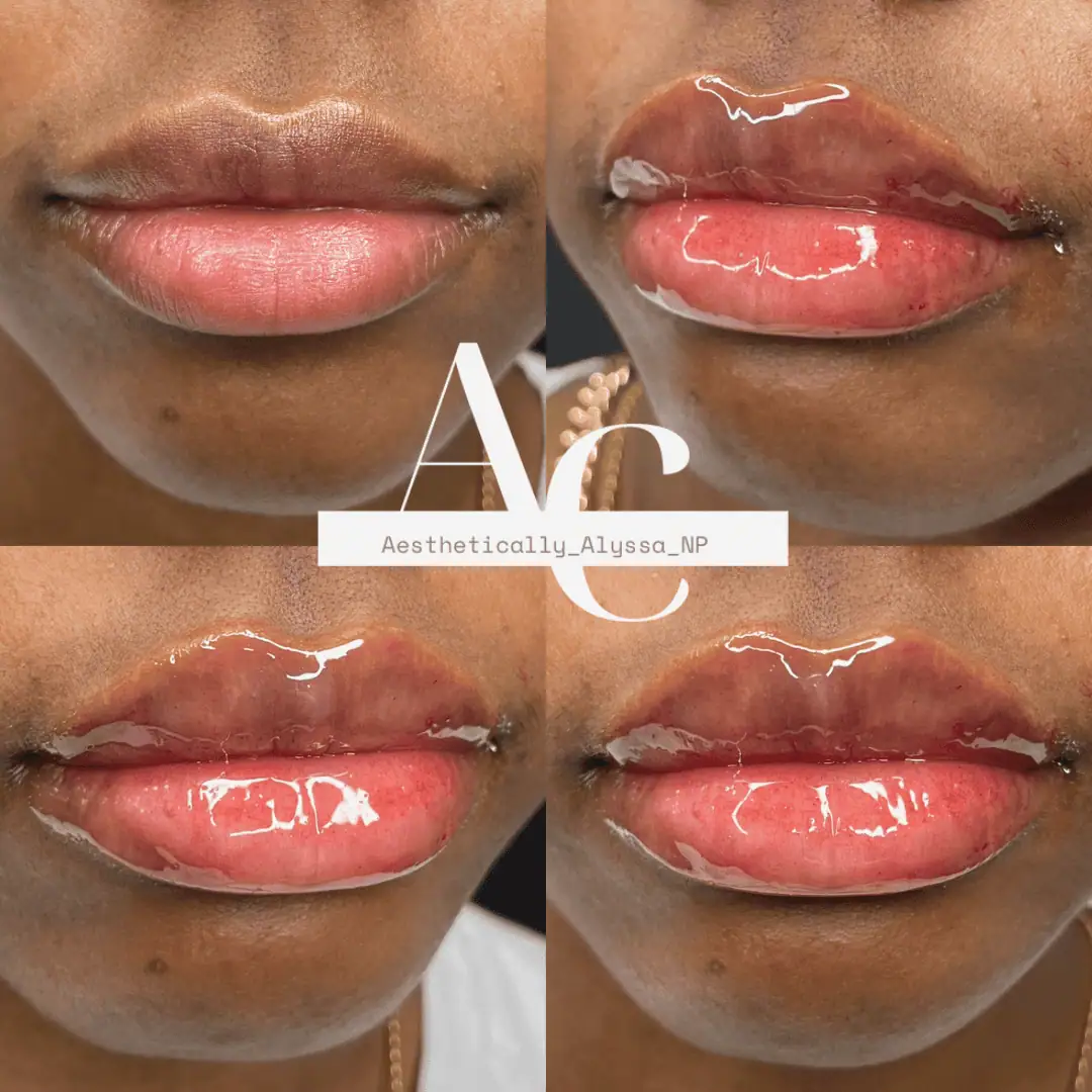 Lip Filler Services in New York by Timelyss Med Spa