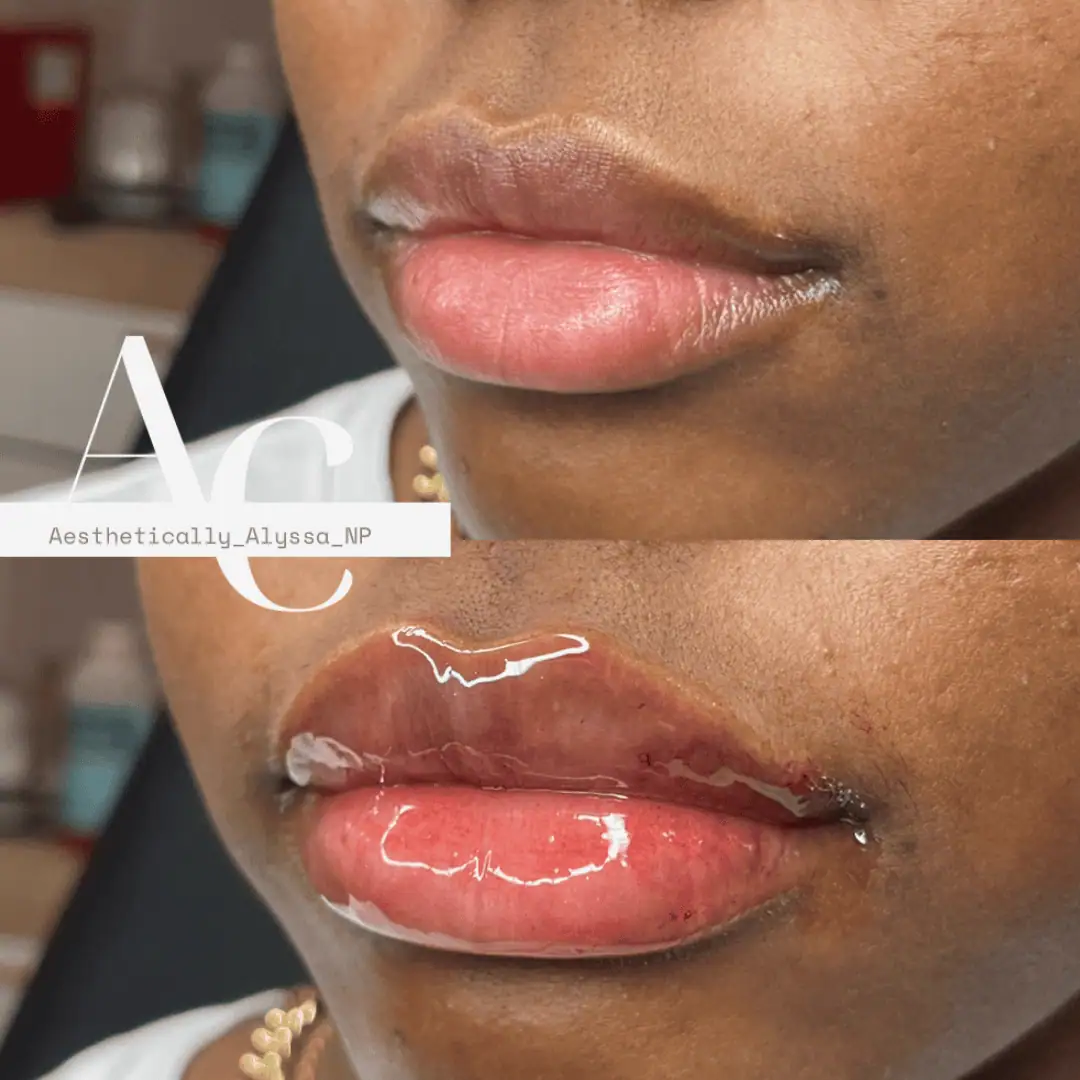 Lip Filler Services in New York by Timelyss Med Spa