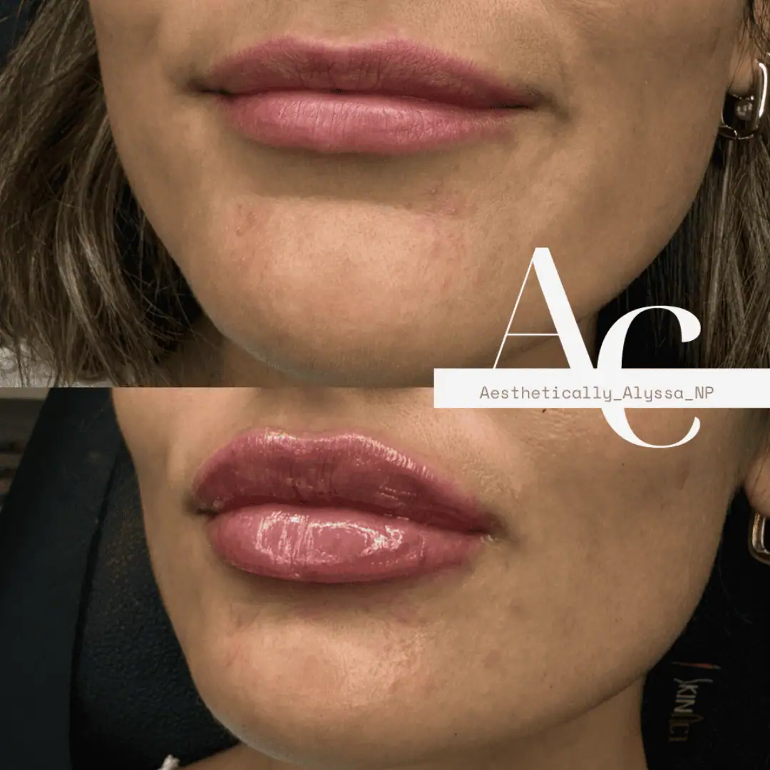 Lip Filler Services in New York by Timelyss Med Spa