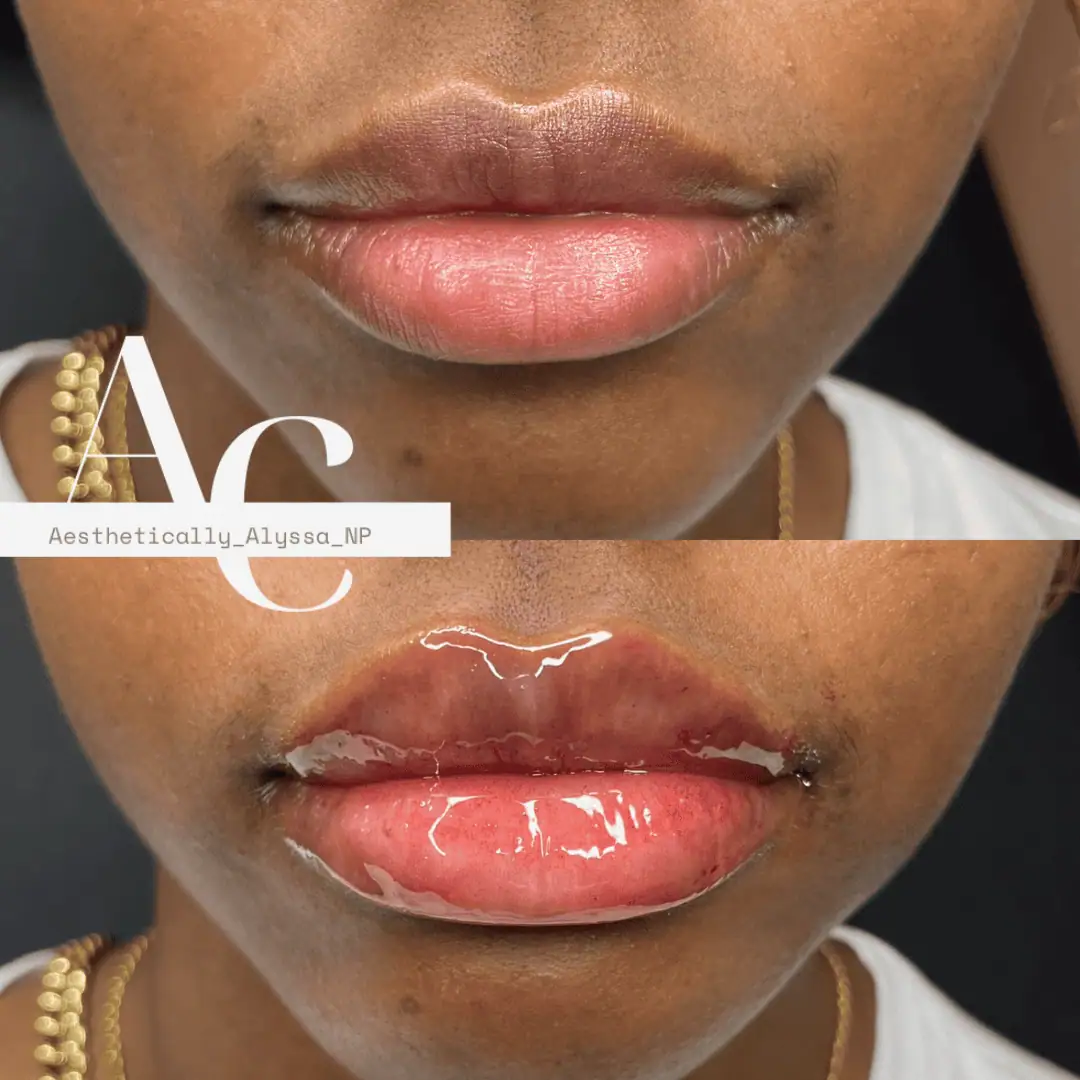Lip Filler Services in New York by Timelyss Med Spa