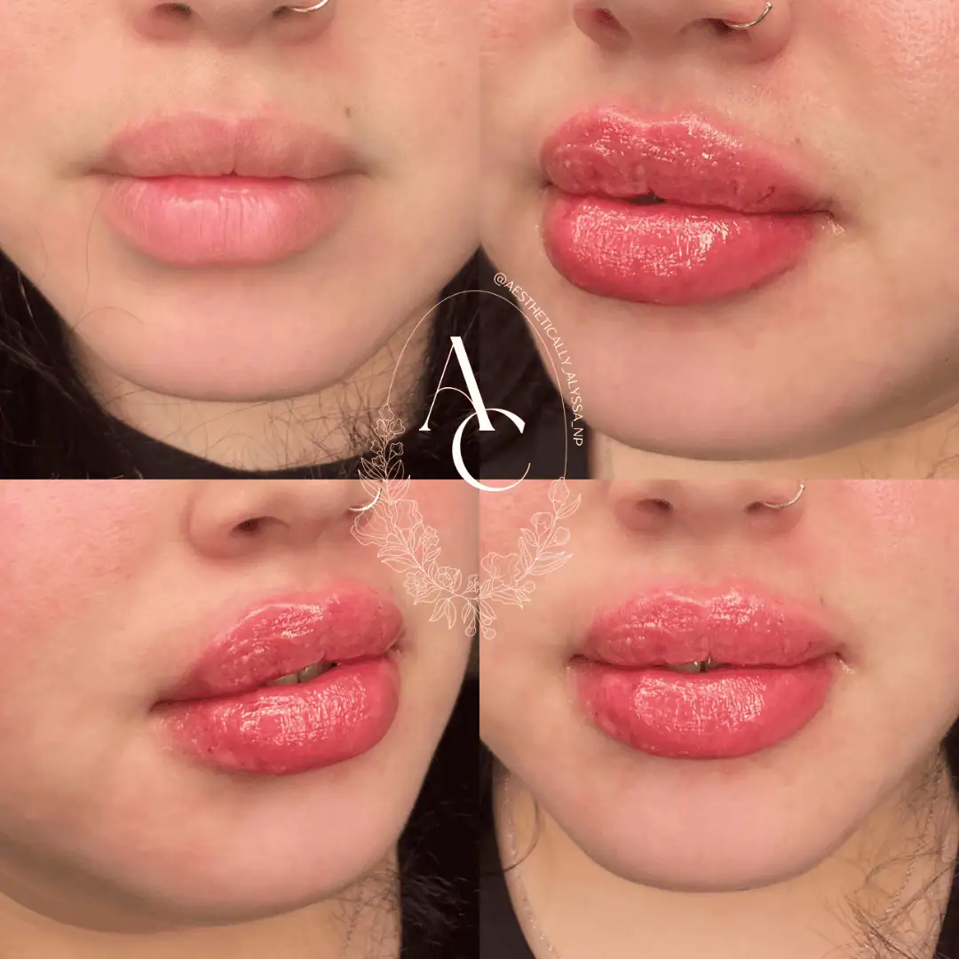 Lip Filler Services in New York by Timelyss Med Spa