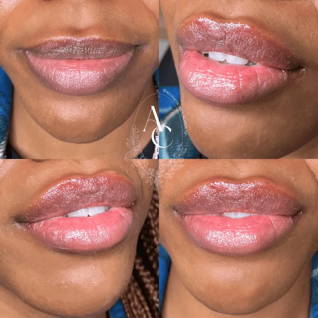 Lip Filler Services in New York by Timelyss Med Spa