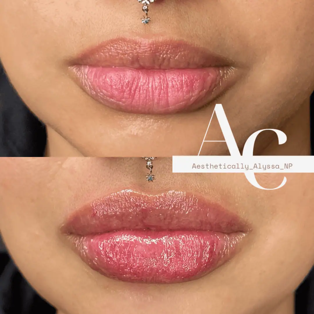 Lip Filler Services in New York by Timelyss Med Spa