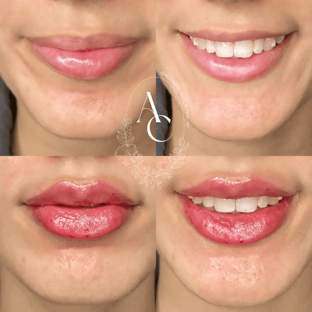 Lip Filler Services in New York by Timelyss Med Spa