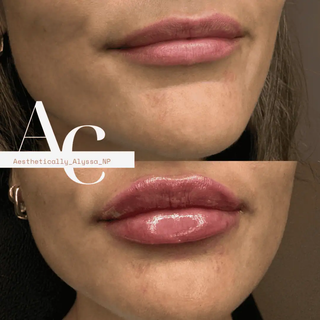 Lip Filler Services in New York by Timelyss Med Spa