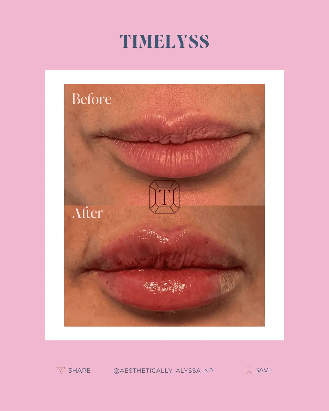 Lip Filler Services in New York by Timelyss Med Spa