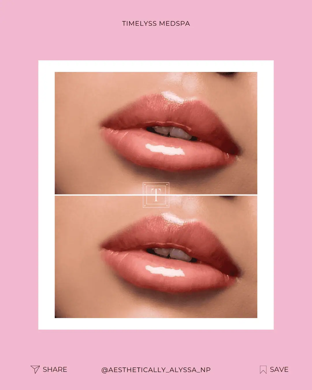 Lip Filler Services in New York by Timelyss Med Spa