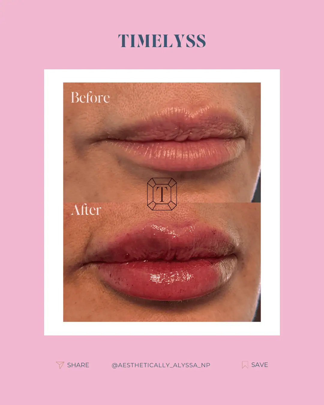 Lip Filler in New York | Timelyss Med Spa