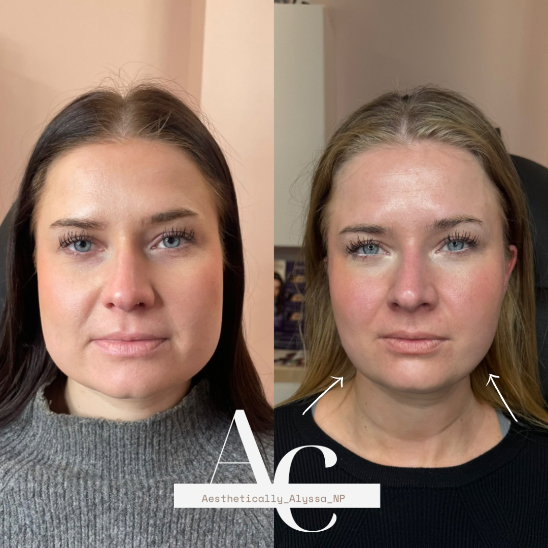 Masseter Tox Services in New York by Timelyss Med Spa