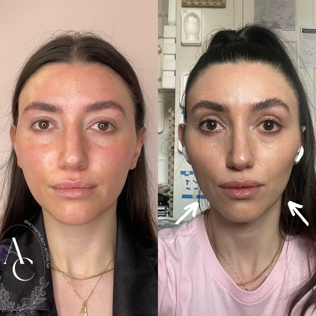 Masseter Tox Services in New York by Timelyss Med Spa