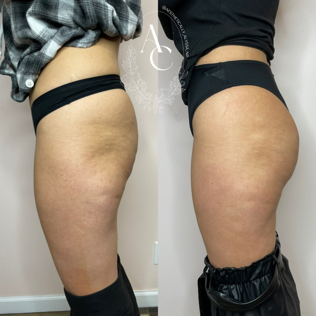 Non Surgical BBL Treatment in New York by Timelyss Med Spa