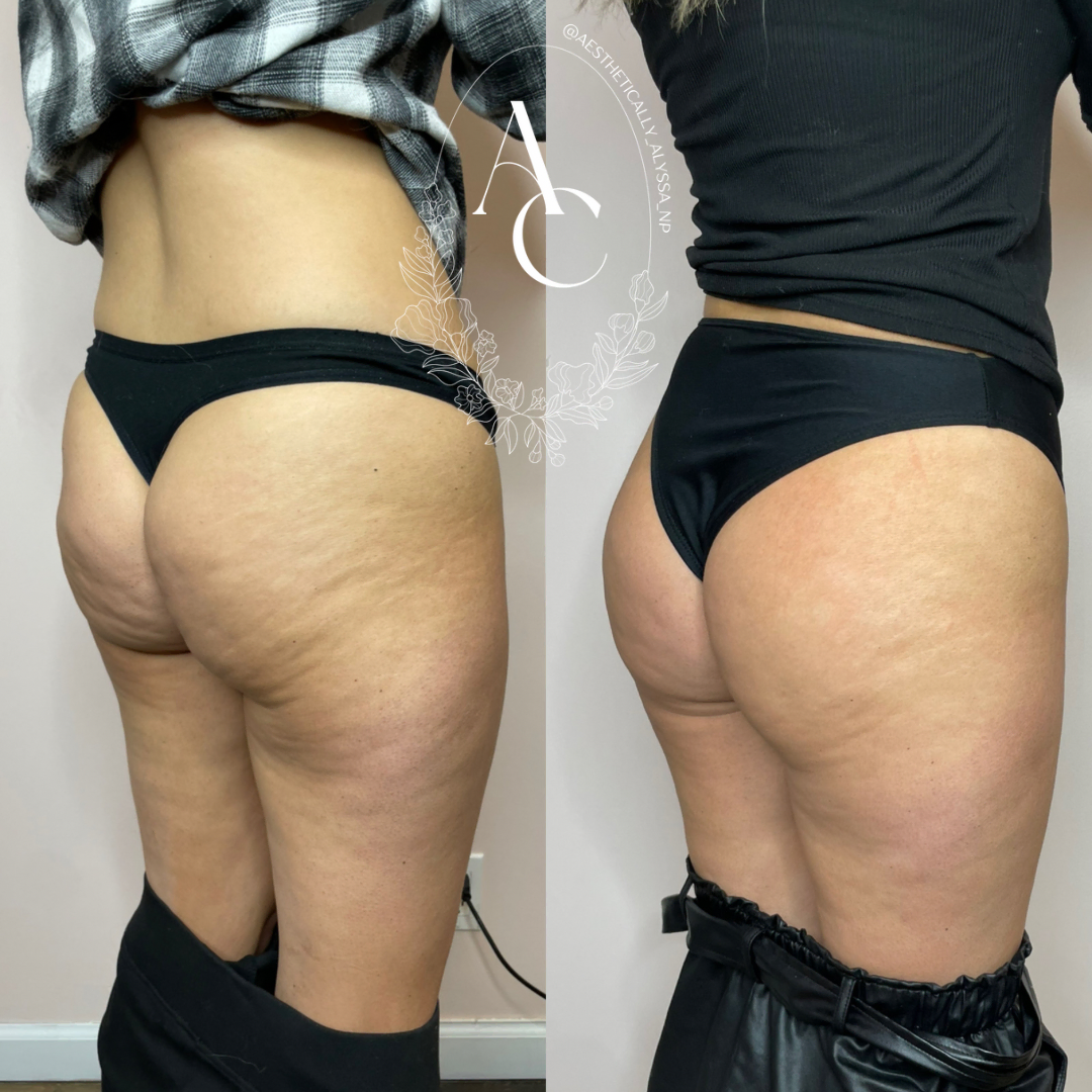 Non Surgical BBL Treatment in New York by Timelyss Med Spa