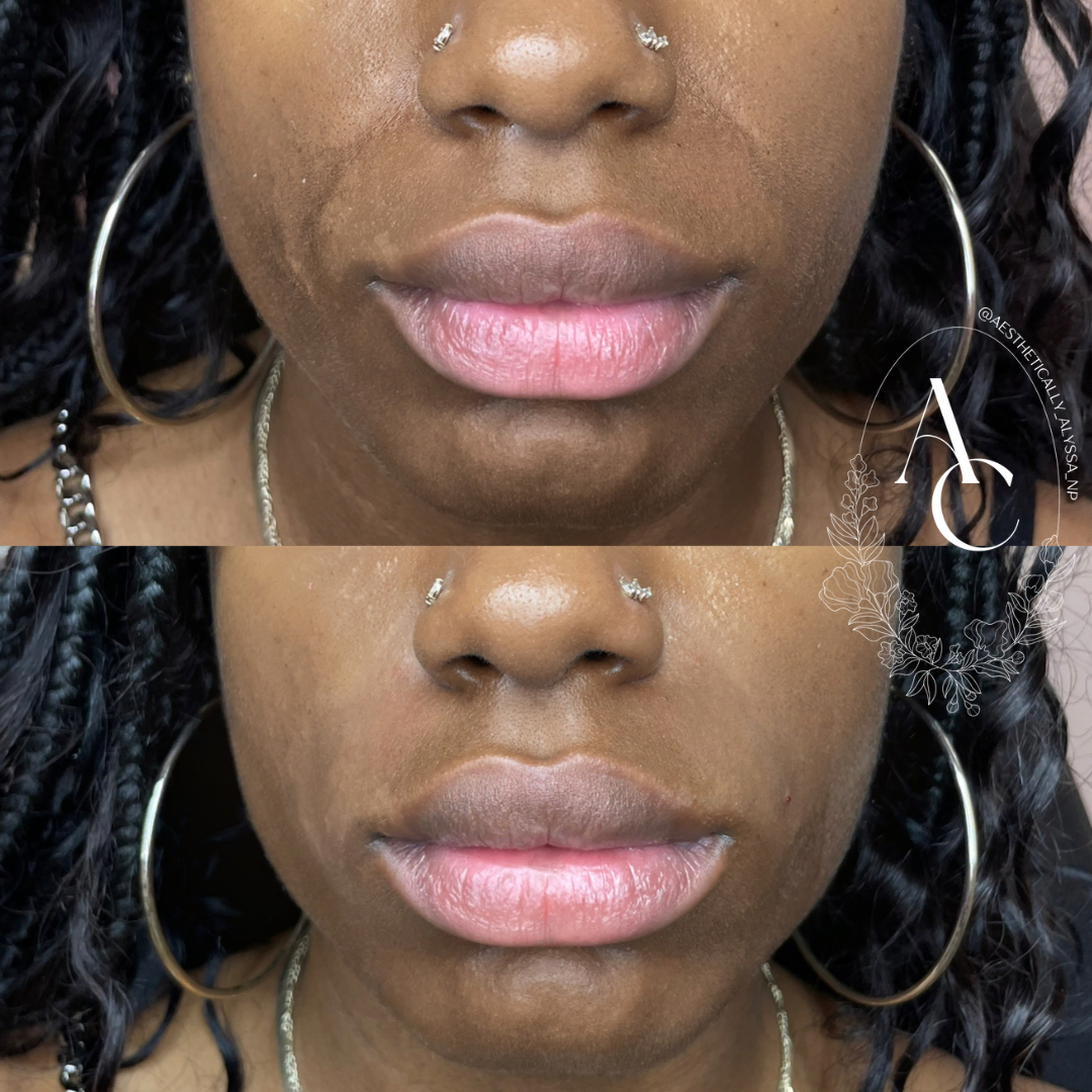 Sculptra in New York by Timelyss Med Spa