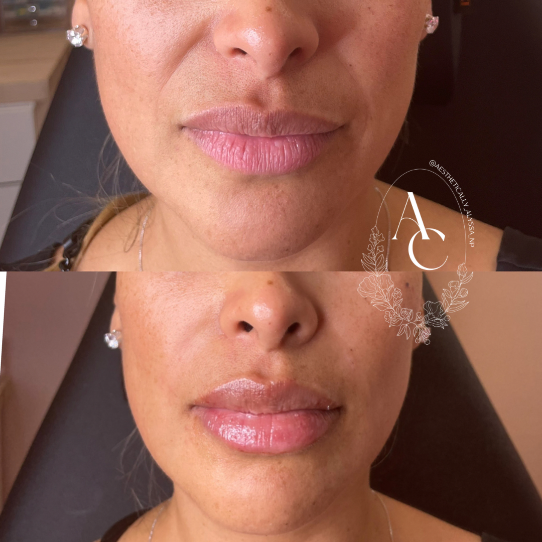 Sculptra in New York by Timelyss Med Spa