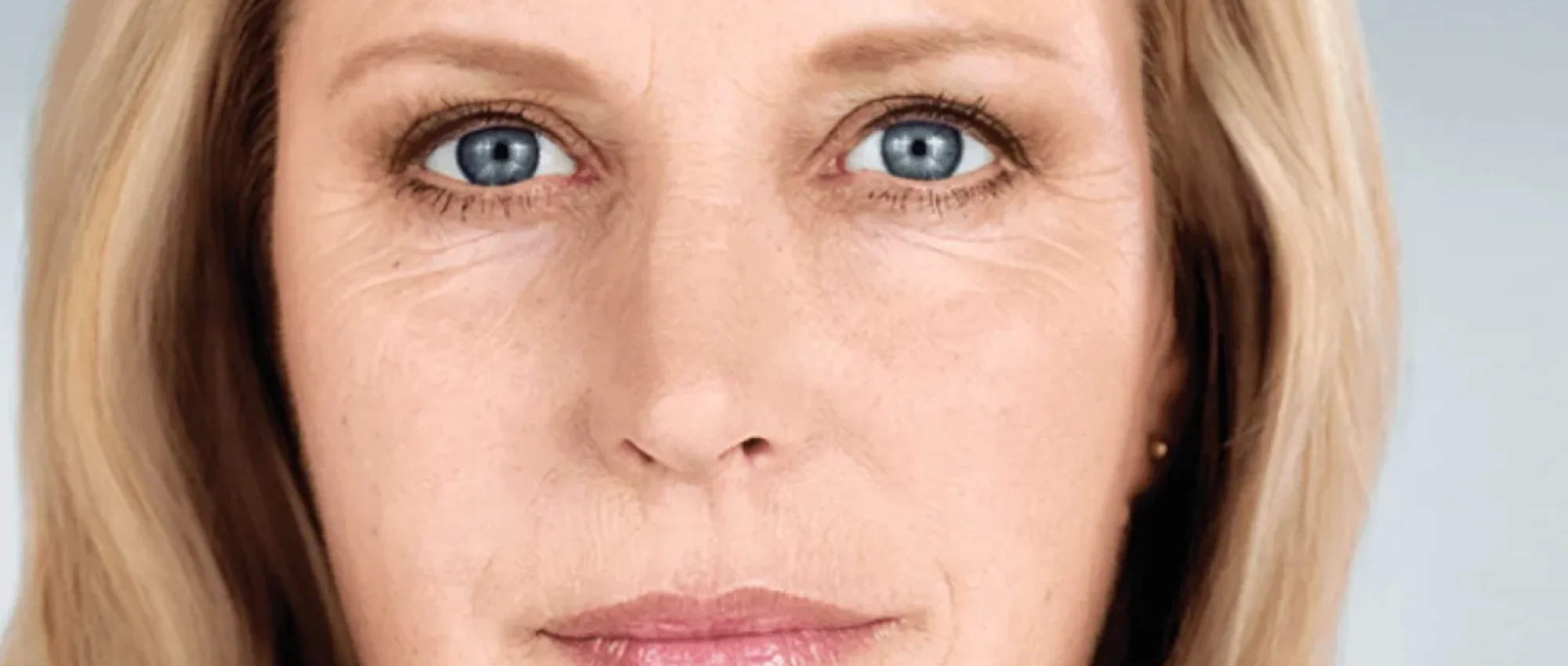 Sculptra Treatment in New York | Timelyss Med Spa