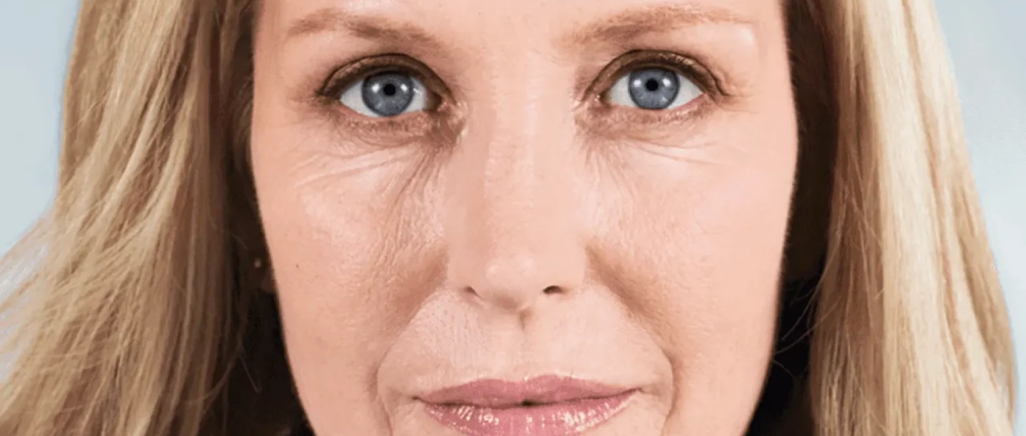 Sculptra Treatment in New York | Timelyss Med Spa