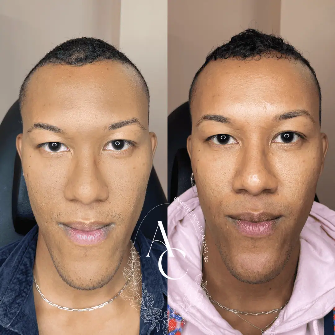 Skinvive Treatment in New York by Timelyss Med Spa