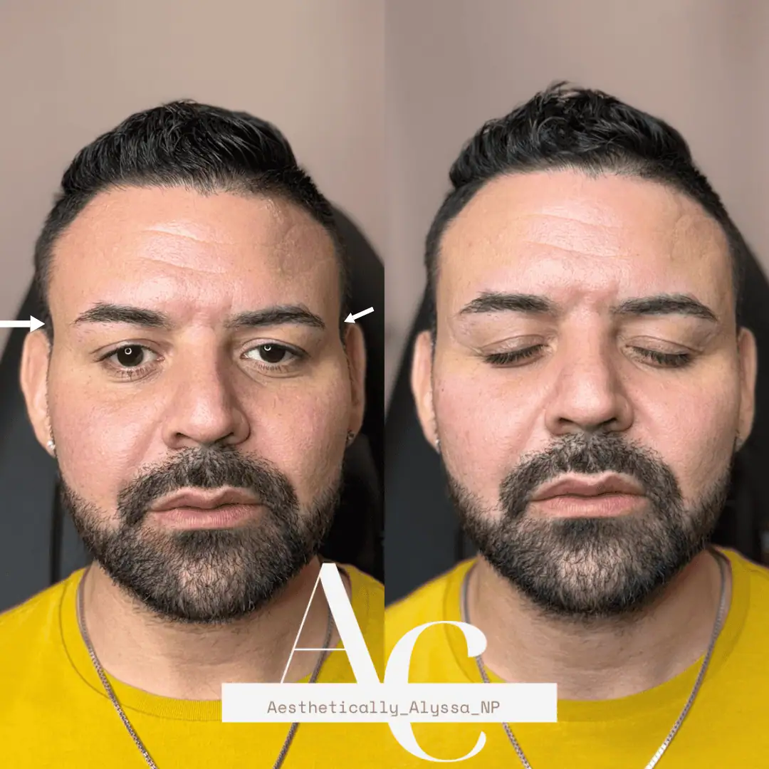 Sculptra in New York by Timelyss Med Spa