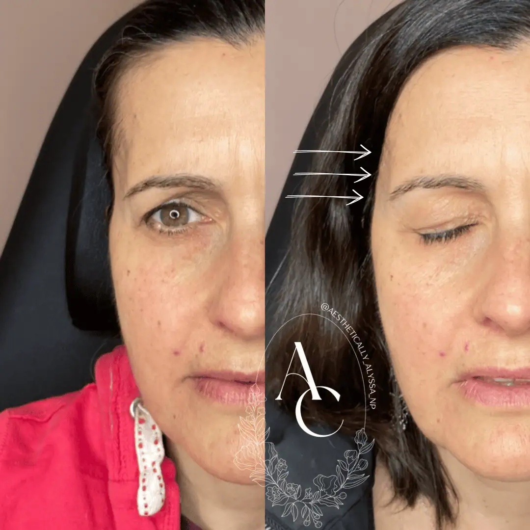 Sculptra in New York by Timelyss Med Spa