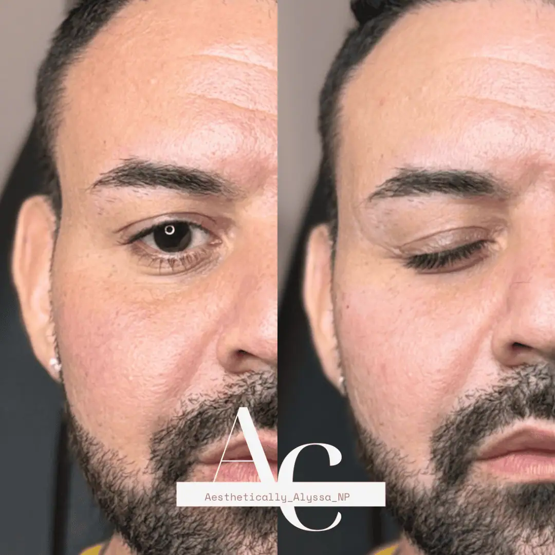 Sculptra in New York by Timelyss Med Spa