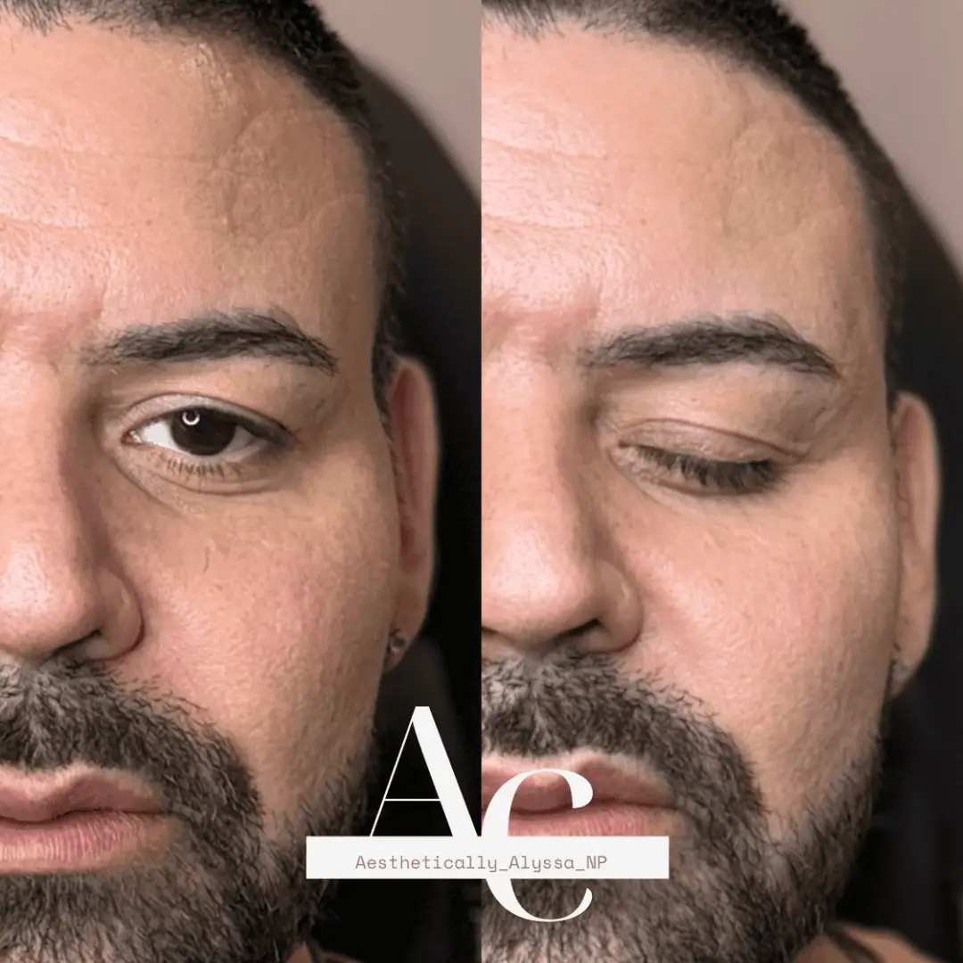 Sculptra in New York by Timelyss Med Spa