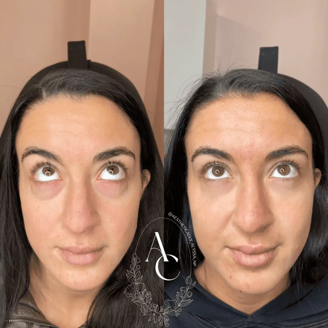 Undereye Filler in New York by Timelyss Med Spa