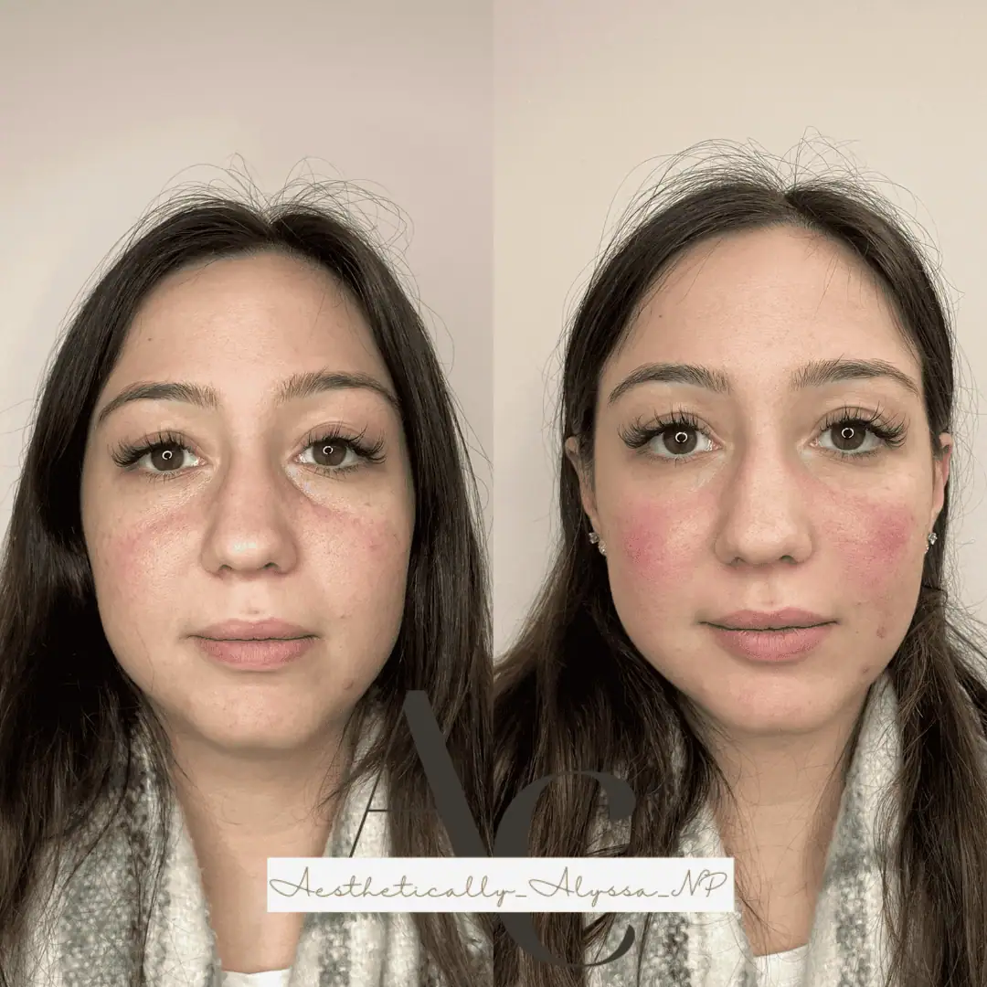 Undereye Filler in New York by Timelyss Med Spa