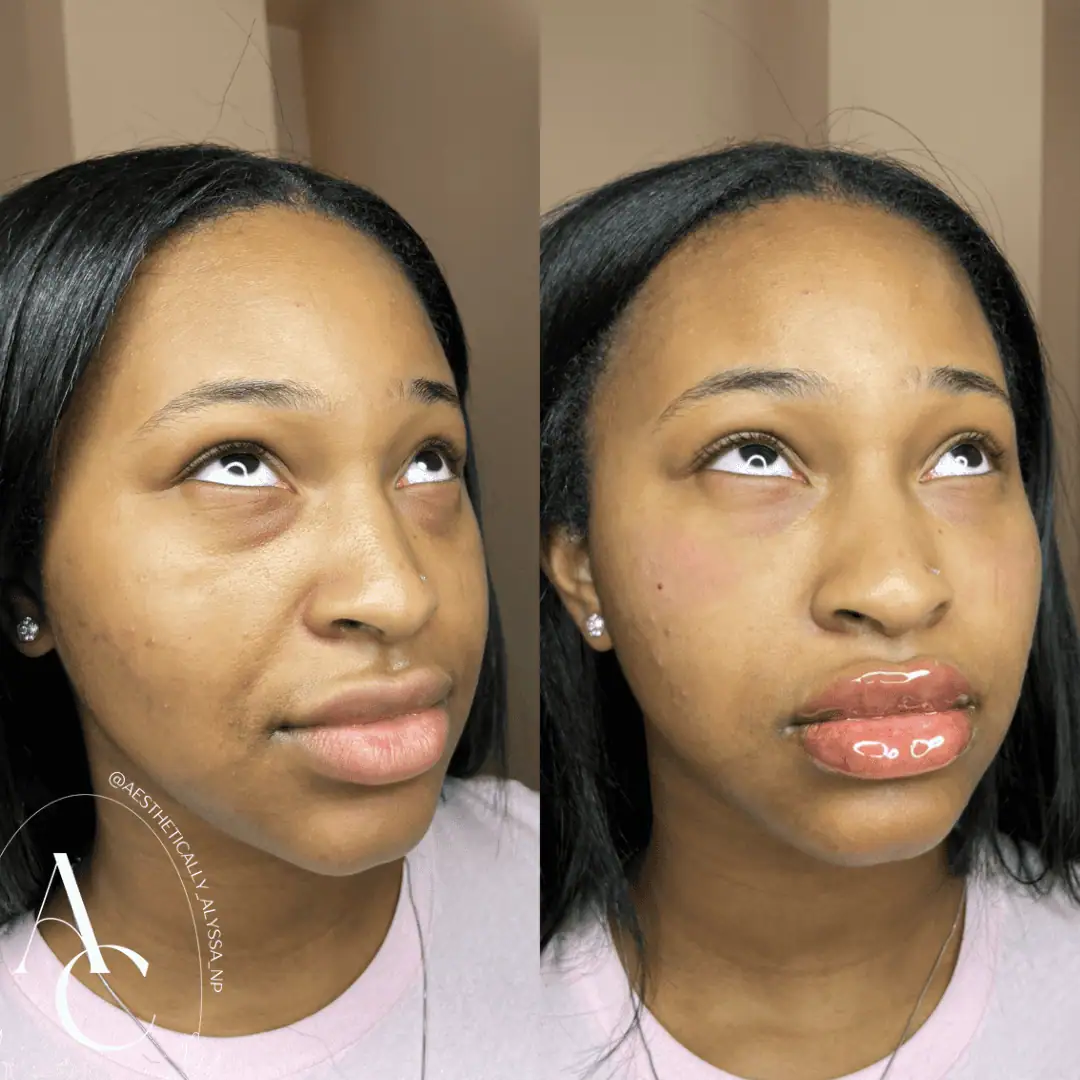 Undereye Filler in New York by Timelyss Med Spa