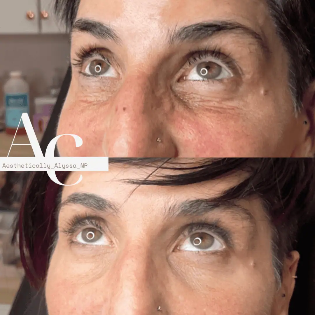 Undereye Filler in New York by Timelyss Med Spa