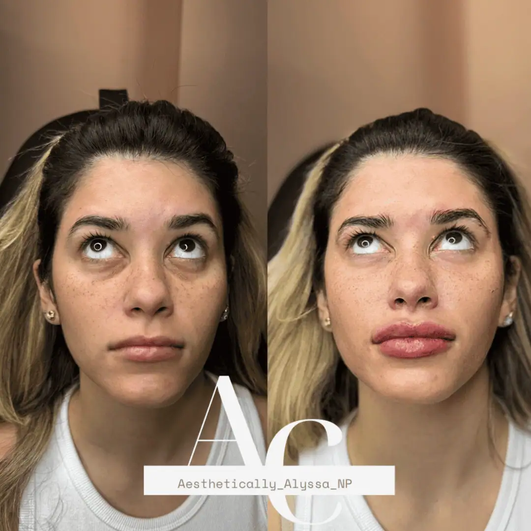 Undereye Filler in New York by Timelyss Med Spa