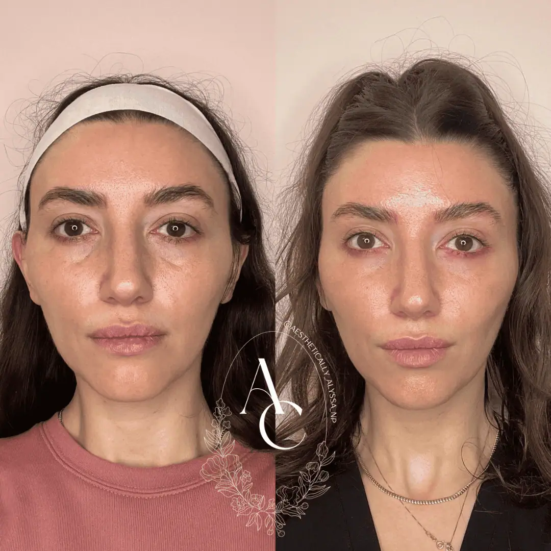 Undereye Filler in New York by Timelyss Med Spa