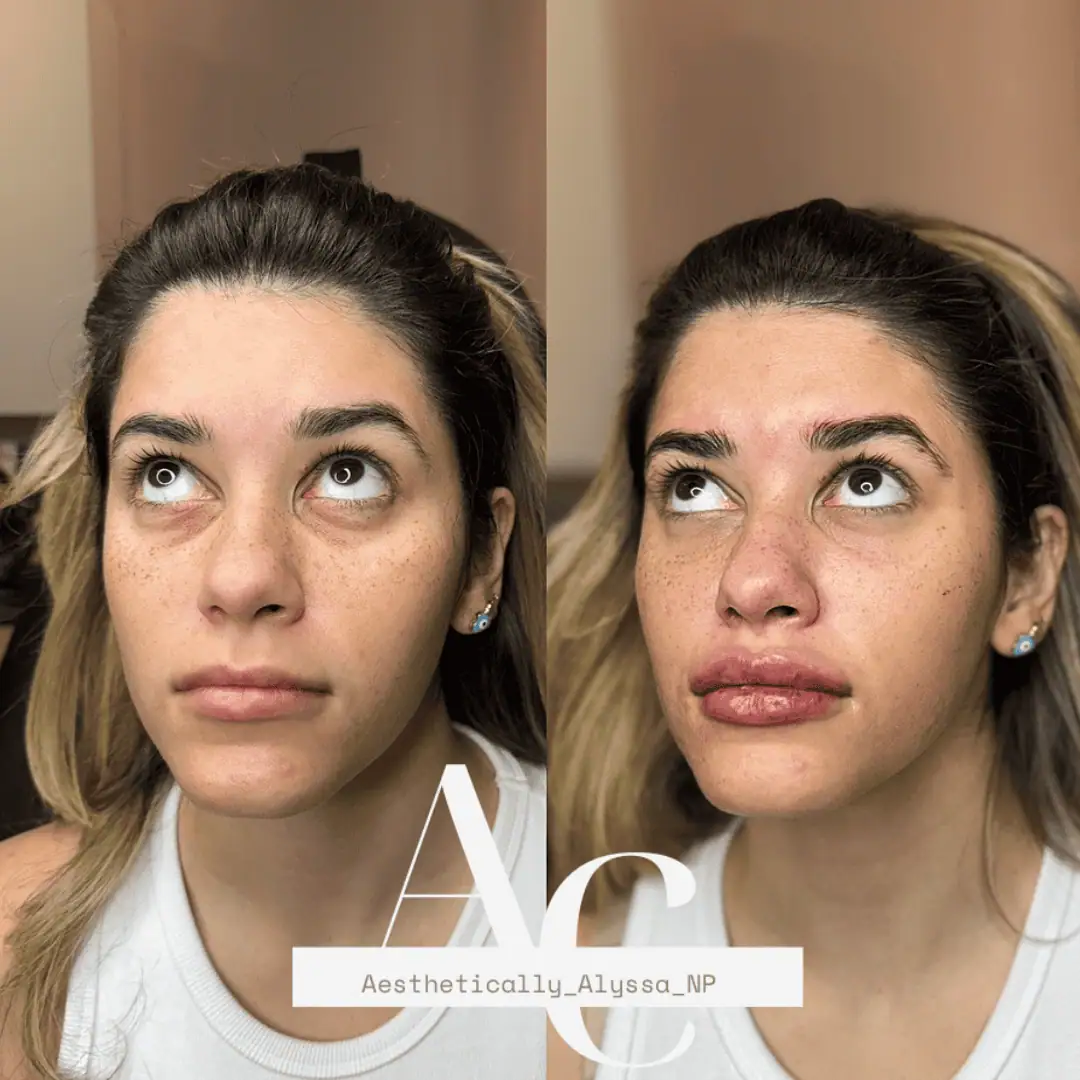Undereye Filler in New York by Timelyss Med Spa