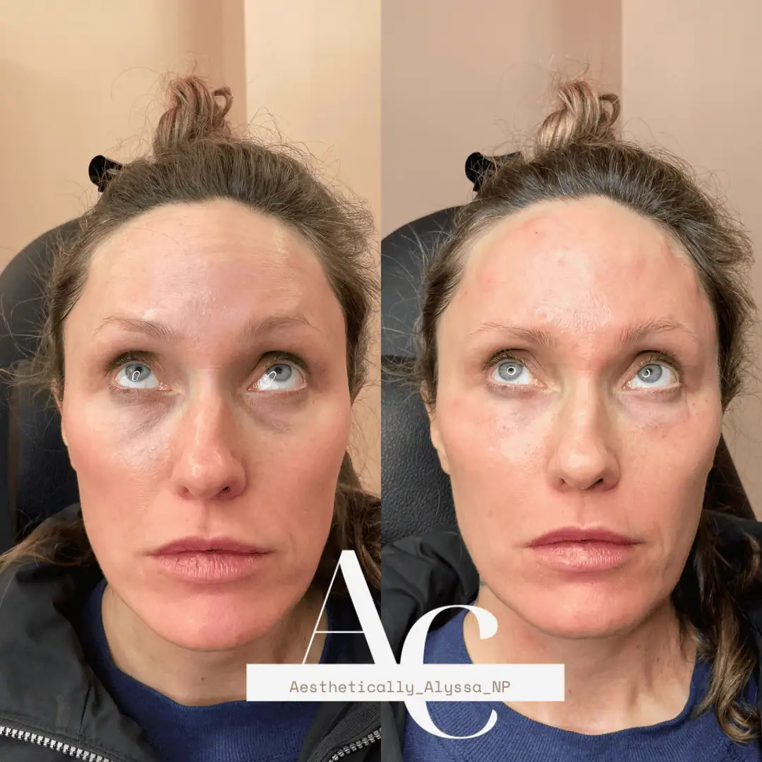Undereye Filler in New York by Timelyss Med Spa