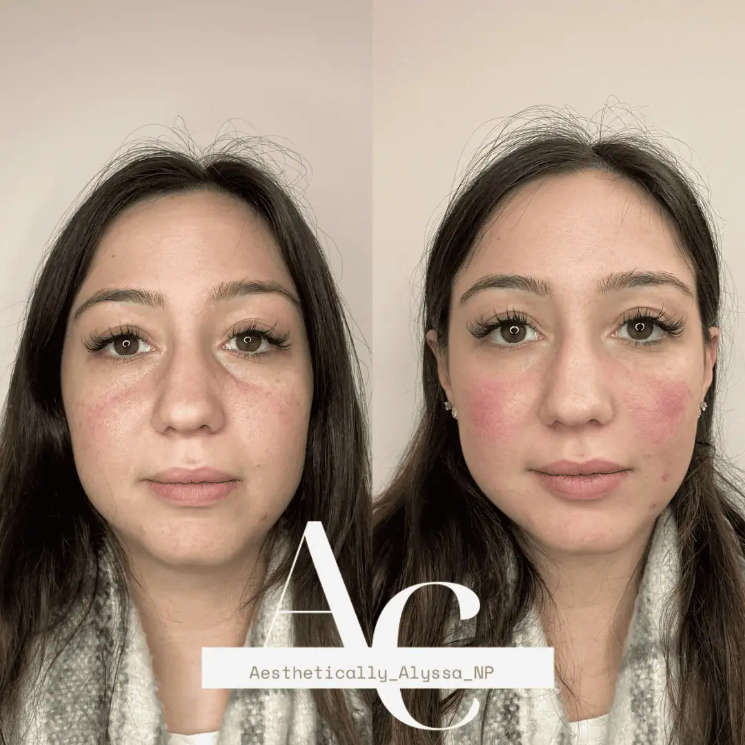 Undereye Filler in New York by Timelyss Med Spa