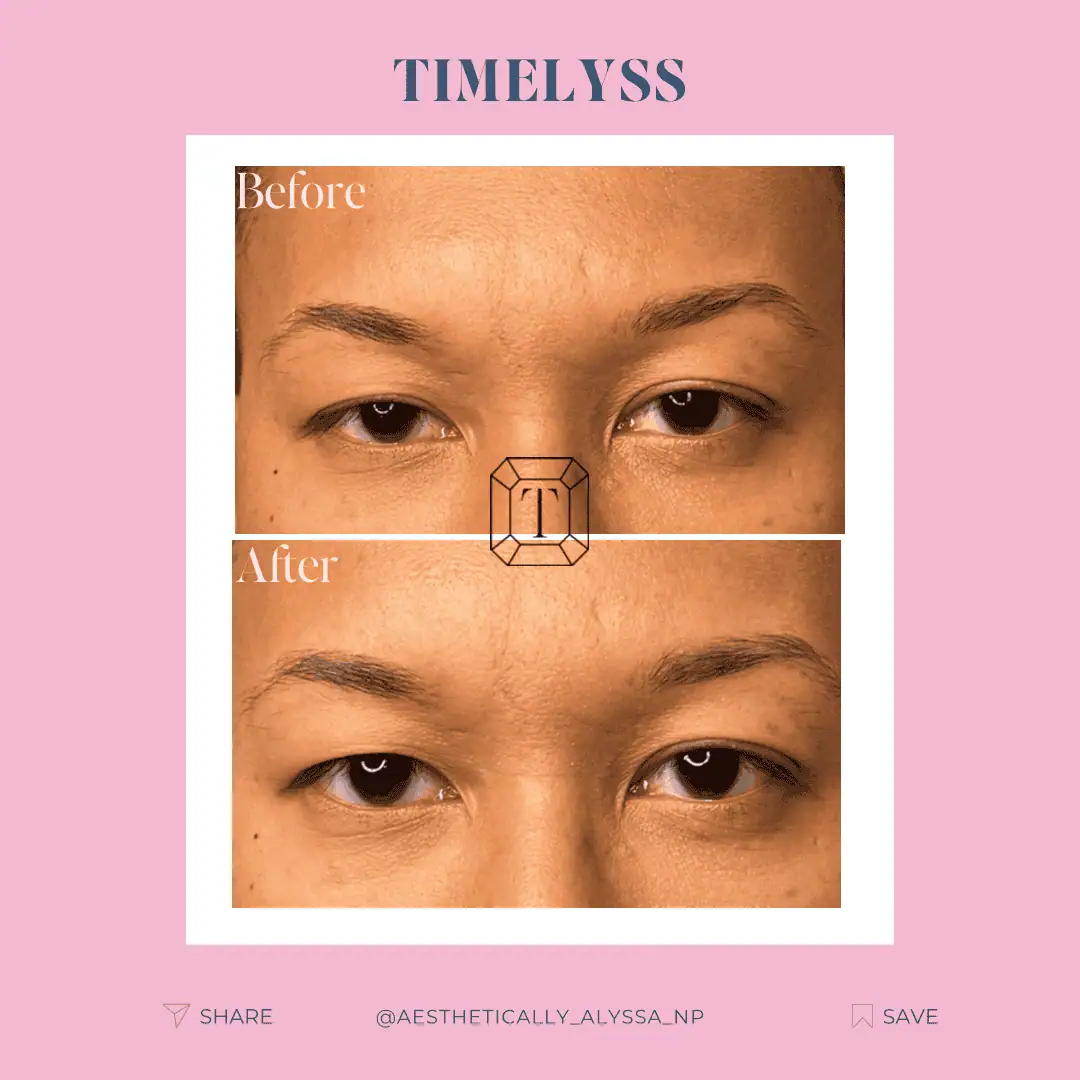 Upneeq for eyes in New York by Timelyss Med Spa