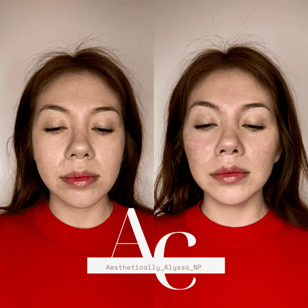 Cheek Filler in New York | Timelyss Med Spa