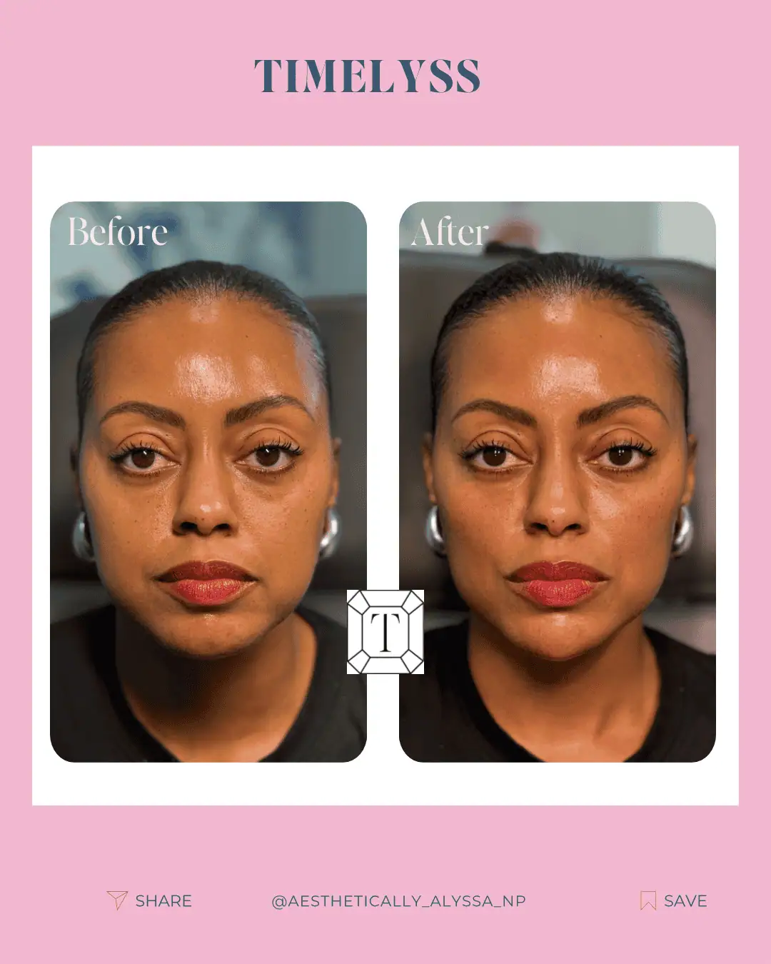 Cheek Filler in New York | Timelyss Med Spa