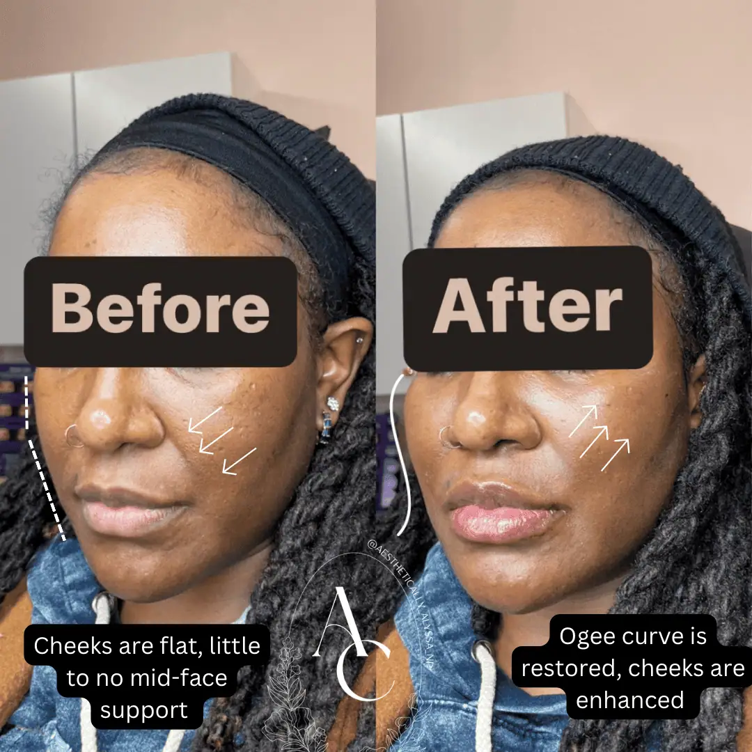 Cheek Filler in New York | Timelyss Med Spa