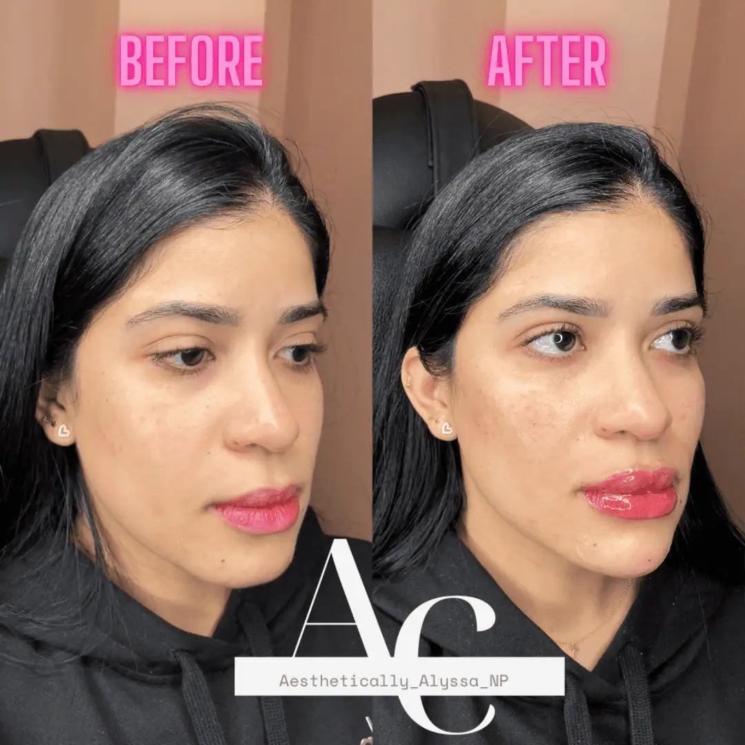 Cheek Filler in New York | Timelyss Med Spa