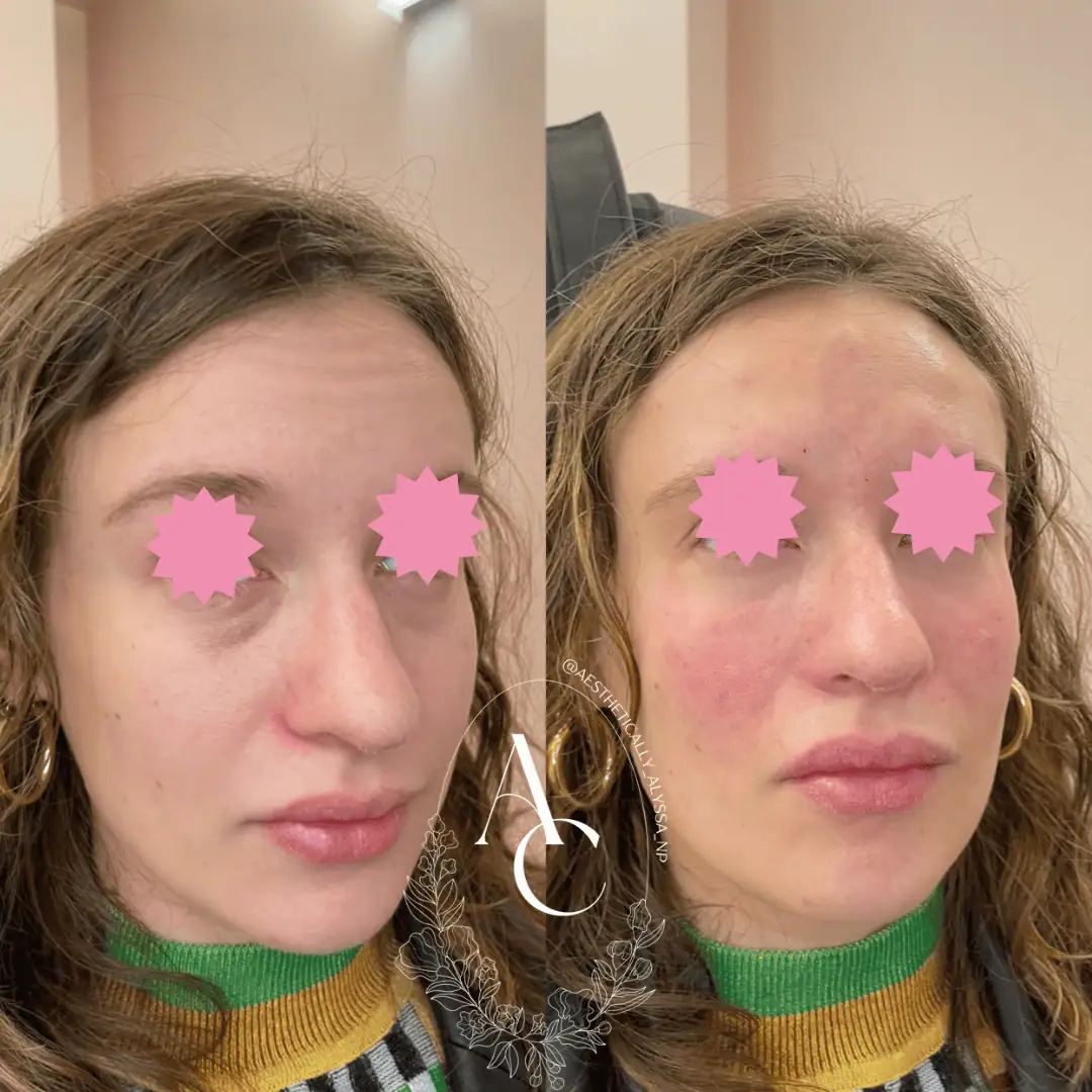 Cheek Filler in New York | Timelyss Med Spa