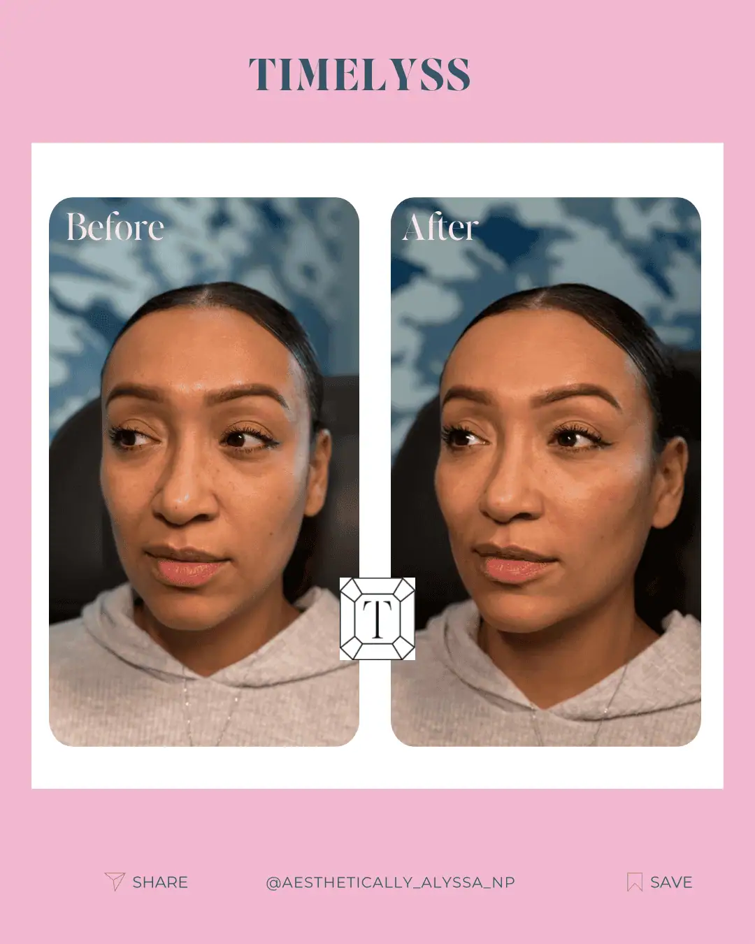 Cheek Filler in New York | Timelyss Med Spa